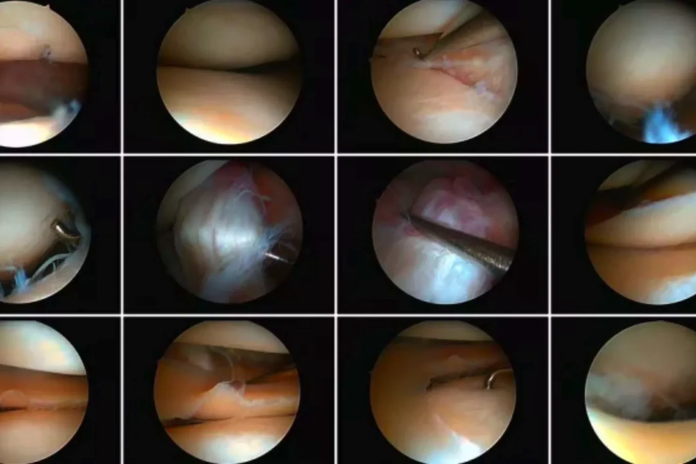 Arthroskopische Operation